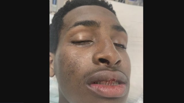 Teen cyclist's jaw broken after allegedly being punched riding through Midtown