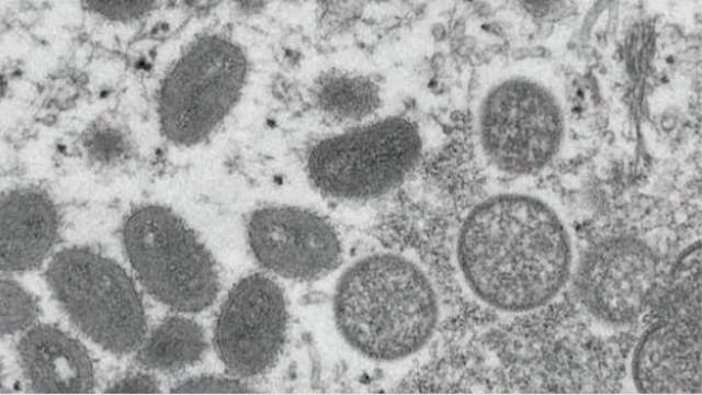 Houston hospitals preparing in case of Monkeypox outbreak