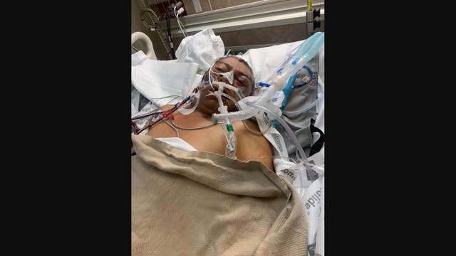 Man mauled by 3 dogs in Huffman dies, had legs, arm amputated