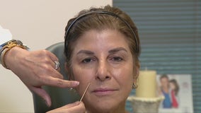 Patients complaining of ‘filler face’ have fillers removed in record numbers