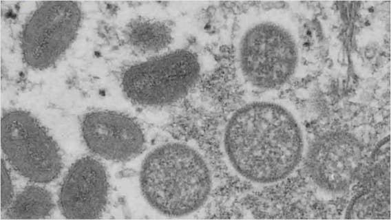 Monkeypox cases continue to rise across in Houston, US