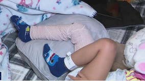 Several agencies investigating after 3-year-old suffers broken femur bone at daycare