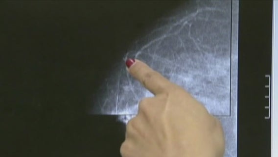 Preventing breast cancer: advice from a doctor you've likely never heard before