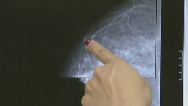 Preventing breast cancer: advice from a doctor you've likely never heard before