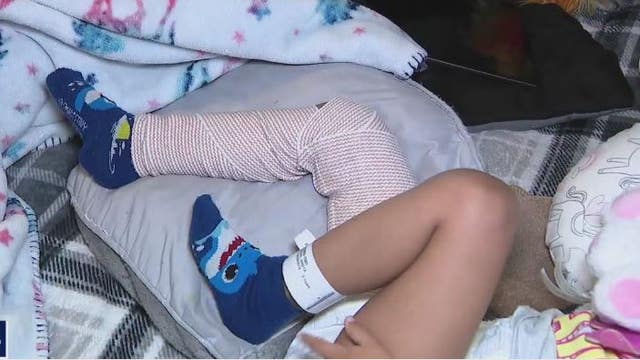 Several agencies investigating after 3-year-old suffers broken femur bone at daycare