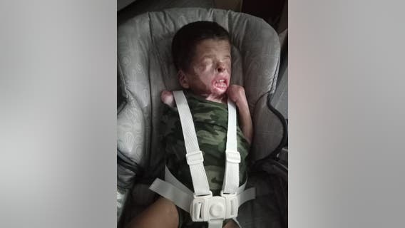 A MIRACLE: Boy born without skin is doing well, now back in Houston