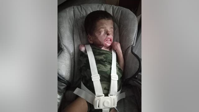 A MIRACLE: Boy born without skin is doing well, now back in Houston