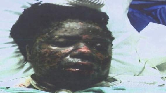 Stevens-Johnson Syndrome: Houston woman loses 60% of her skin from rare condition