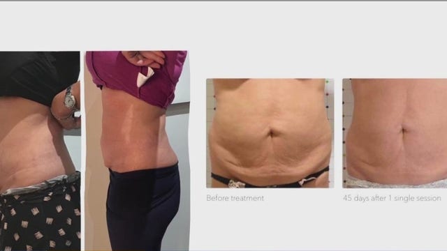 Body contouring: New technology treatment aims to melt cellulite with microwave technology