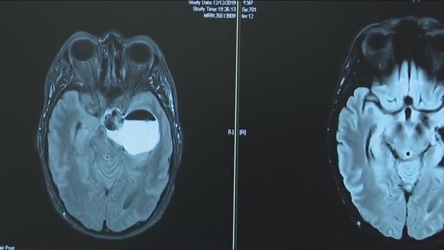 Houston-area woman undergoes surgery for brain tumor after anxiety, memory loss, vision problems
