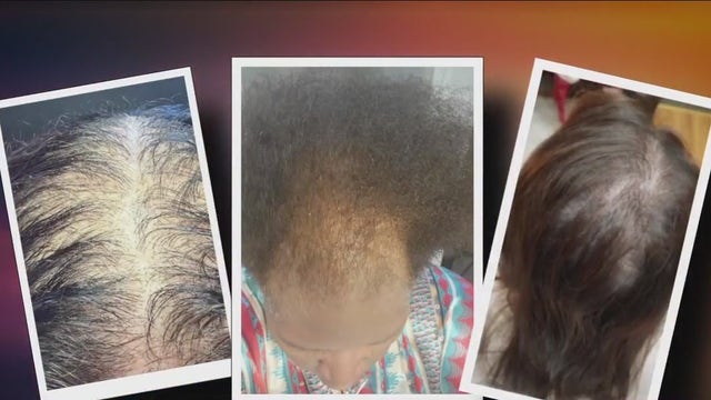 Houston woman helps restore confidence and hair growth