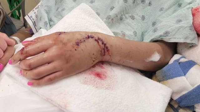 Shark bites 19-year-old at Galveston beach, severed her tendons