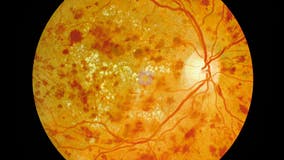 Preventing blindness caused by diabetes