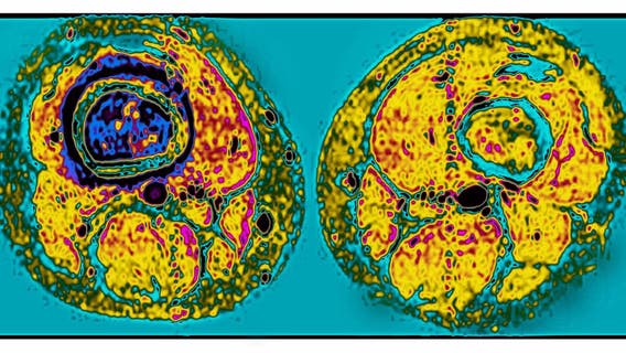 What is Osteosarcoma?