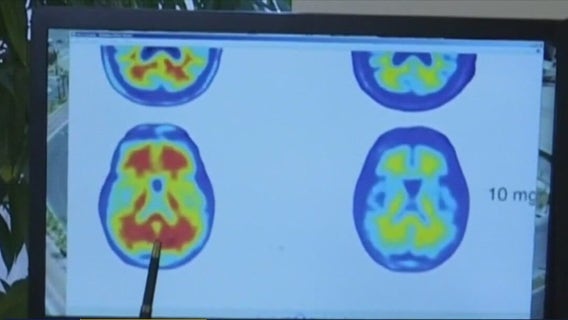 Alzheimer's disease could be reversed with investigational drug