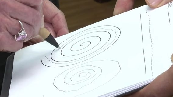 Ultrasound treatment stopping tremors without surgery