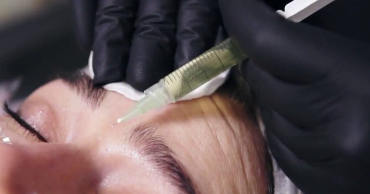 What is 'zombie filler'? Doctors use donor fat to restore volume
