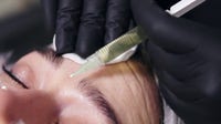 What is 'zombie filler'? Doctors use donor fat to restore volume