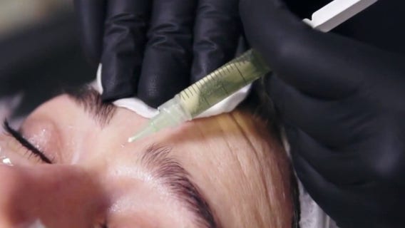 What is 'zombie filler'? Doctors use donor fat to restore volume