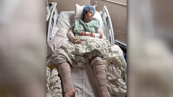 Mother of four hospitalized after dog attack in Polk County