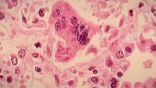 Officials: Student at William Penn High School diagnosed with mumps