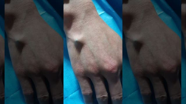 Man needs chopstick surgically removed from hand after attempting beer bottle trick, doc says