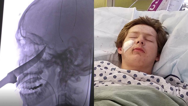 Kansas teen miraculously survives 10-inch knife in face: 'It was really shocking'