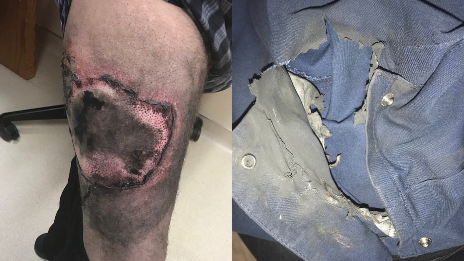 Photos show Nader Harb’s burn injury and pants after an extra lithium-ion battery for his vape pen exploded. (Photo credit: Provided via attorney Tom Merriman)
