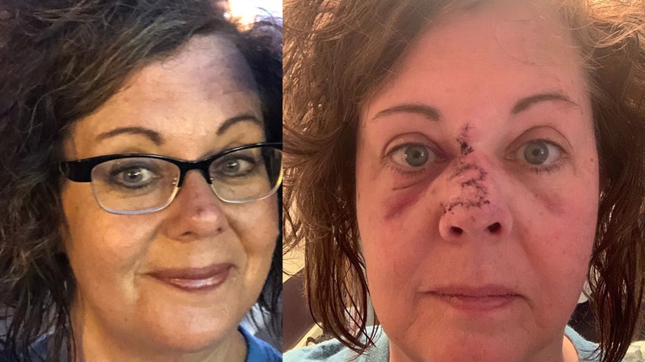 Lisa Ryan is pictured in an image taken in 2017, before her skin cancer diagnosis, alongside a photo during her recovery from three surgeries and reconstruction. (Photo credit: Lisa Ryan)