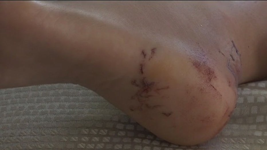 Sarasota, Florida teen bitten by shark while on vacation.