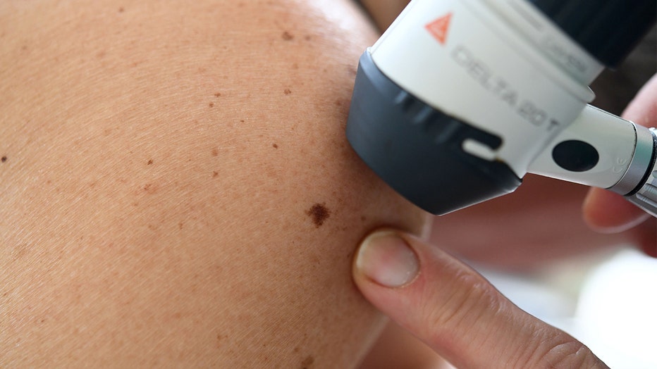 A dermatologist checks moles on a patient. Routine visits to the dermatologist can help catch potential cancerous moles early on.