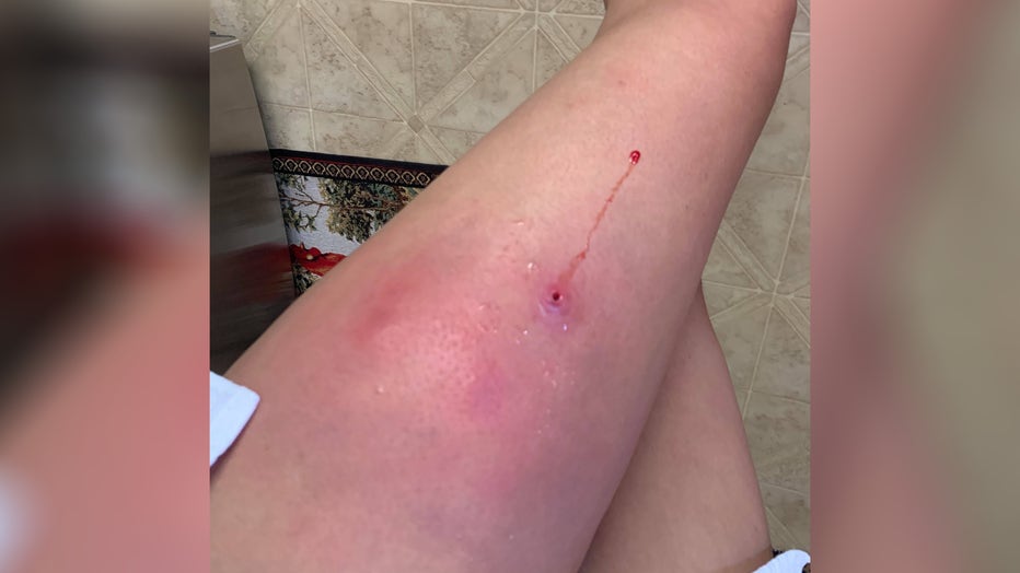 A photo shows the infection in Amanda Edwards' leg. The Virginia resident was prescribed antibiotics as part of her treatment. (Photo credit: Amanda Edwards)