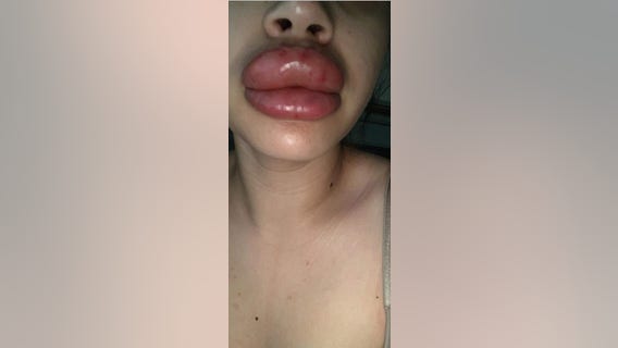 Valley women claim botched lip injections caused severe infection