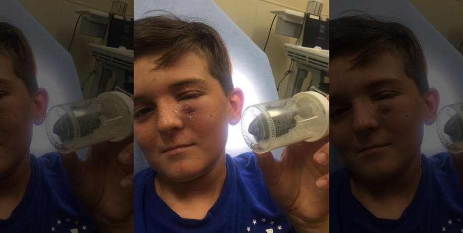 Fishing accident leaves 11-year-old with hook in his eyelid