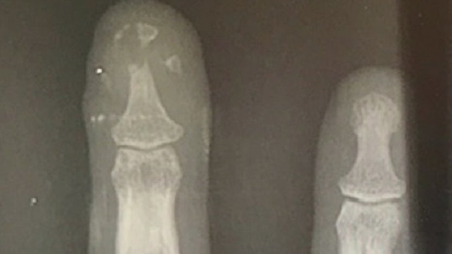 A St. Petersburg, Florida doctor created and successfully implanted the nation's first 3D printed finger bone.