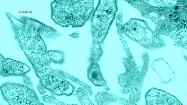 Officials: Case of mumps confirmed at Ridley High School