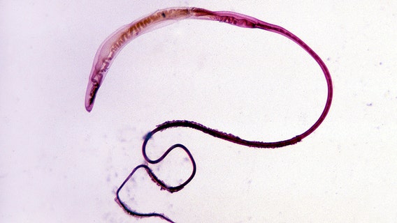 Woman’s eyes infected with parasitic worms possibly after encounter with swarm of flies while on run, study says