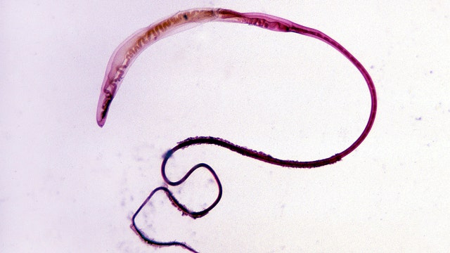 Woman’s eyes infected with parasitic worms possibly after encounter with swarm of flies while on run, study says