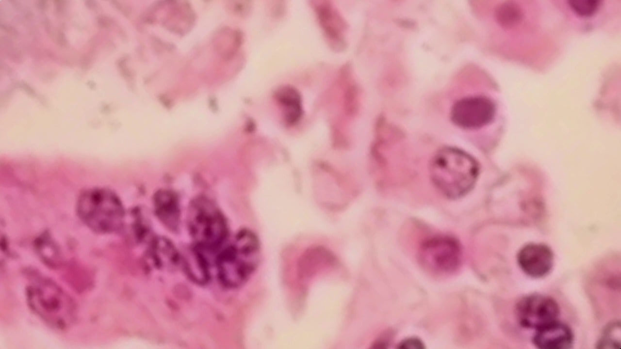 Possible Measles Exposure Reported at Philadelphia International Airport, Health Officials Warn