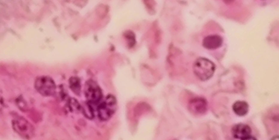 Pennsylvania confirms first measles-related deaths in 35 years