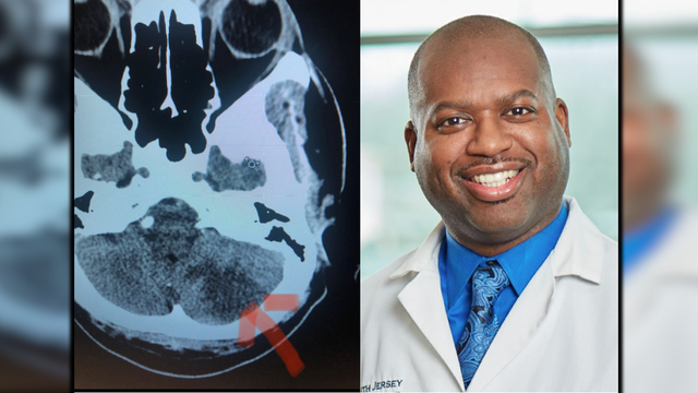 NJ cardiologist suffers stroke likely due to COVID-19 while recovering