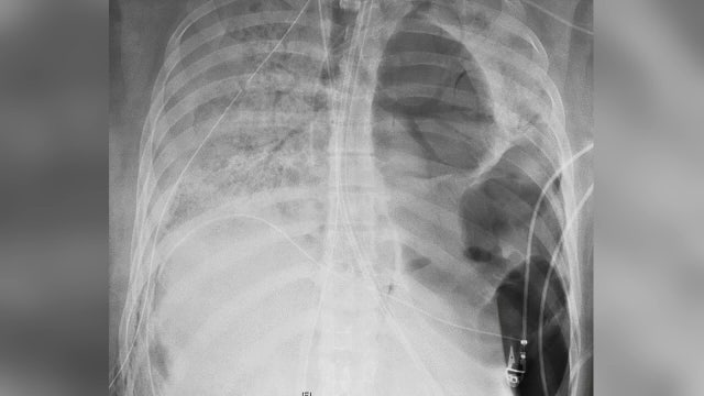 COVID-19 damages lungs of asymptomatic and most severe patients alike, scientists believe