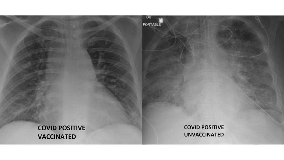 side-by-side-covid-lung-white-background.jpg?ve=1&tl=1