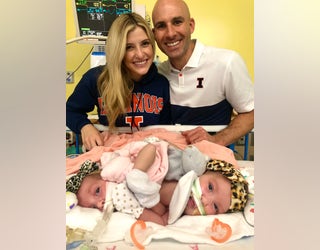 How are the Altobelli conjoined twins doing today? All the details