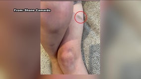 Parents searching for answers after son got unexplained bruises at New Jersey daycare