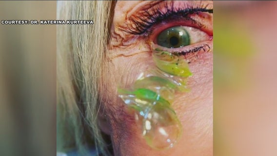 VIDEO: Newport Beach doctor removes 23 contact lenses from woman's eye