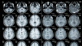 Cluster of brain infections left children ‘incredibly sick’: CDC monitoring