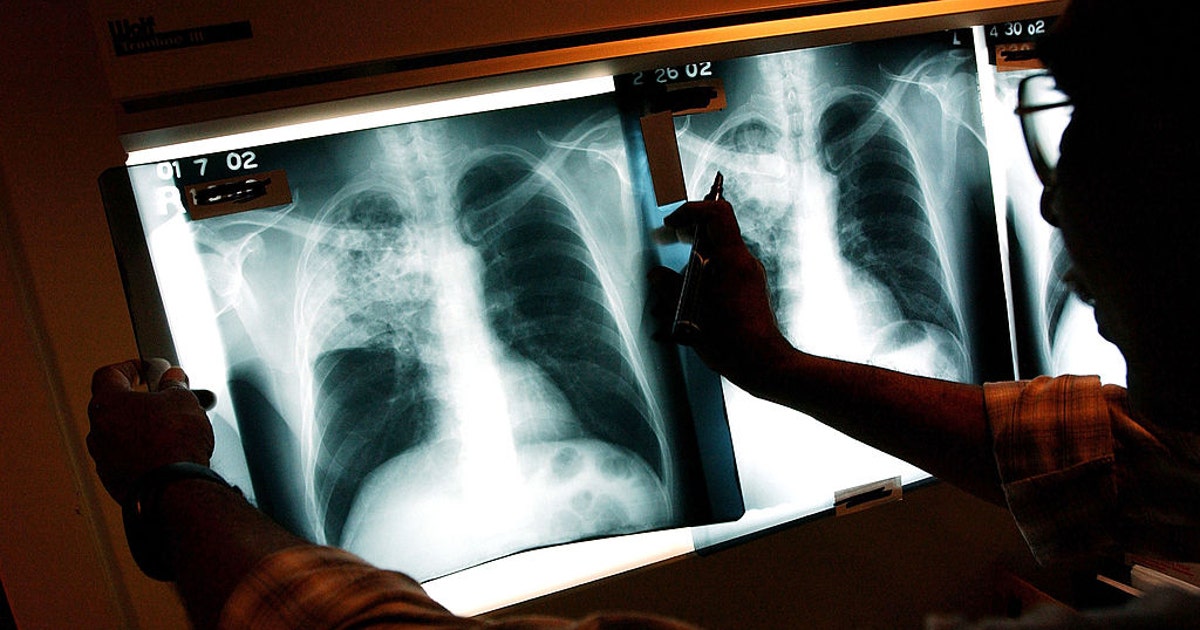 Camden County resident diagnosed with active tuberculosis; health officials investigating