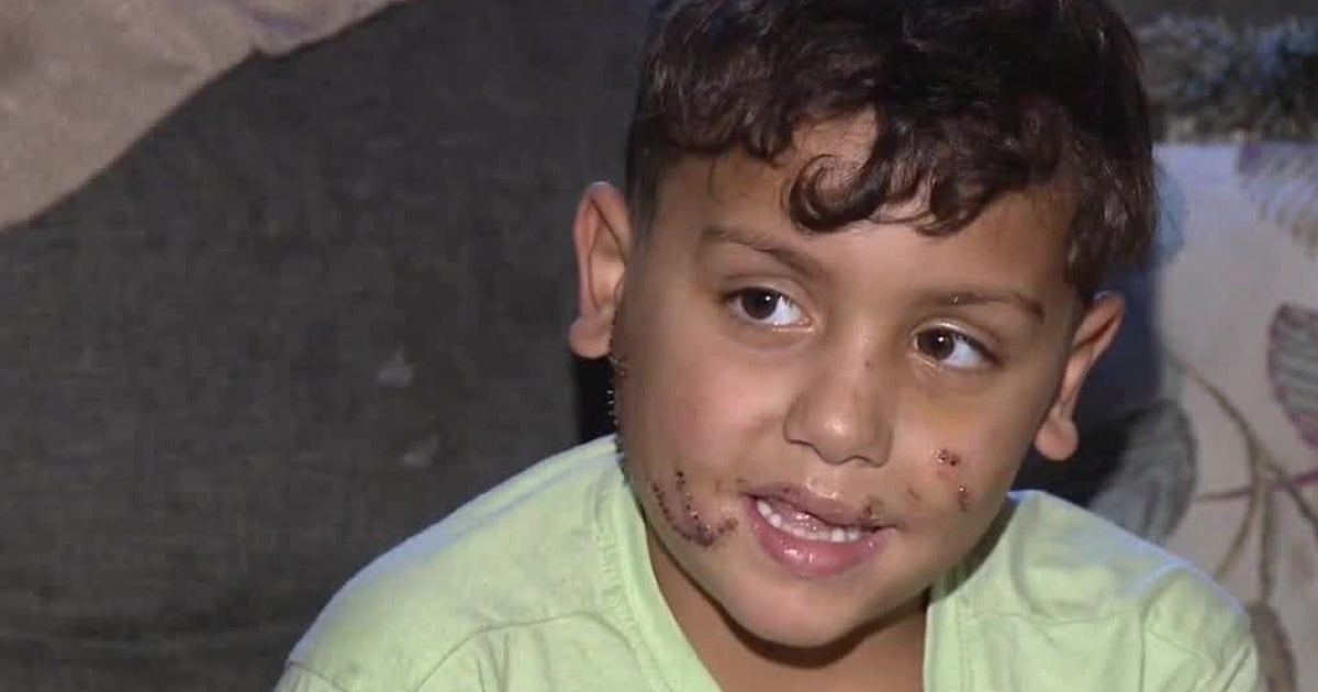 7-year-old boy attacked by dog in Philly receives over 100 stitches ...
