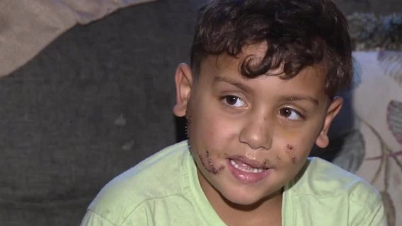 7-year-old boy attacked by dog in Philly receives over 100 stitches; family seeks justice